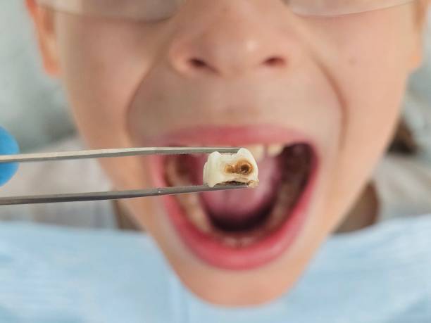 Best Emergency Broken Tooth Repair in Alba, NY