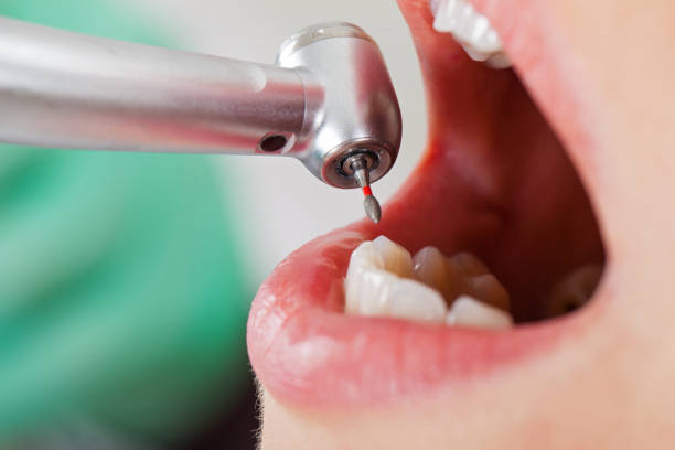 Best Emergency Wisdom Teeth Removal in Alba, NY